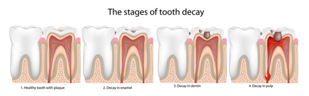 Dental Care – Reduce Tooth Decay or Tooth Loss