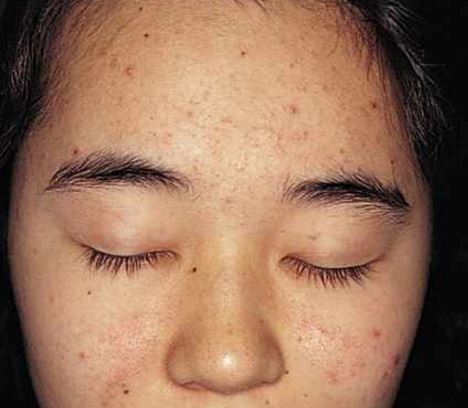 Remove Pimple Marks / Acne Marks&nbsp;Overnight
