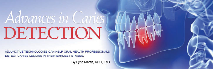 caries-detection