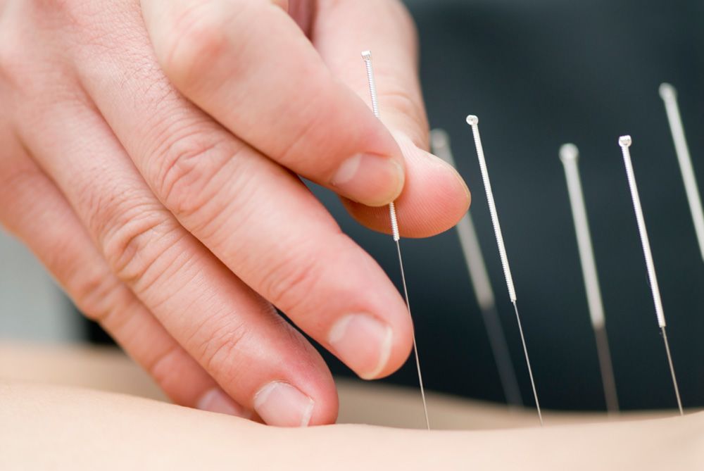 Amazing Effect of Acupuncture on The Modern&nbsp;World